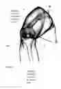 Fig. 03 - System of designing a guide tool and/ or surgical kit tools and/or an implant comprising a positioning mark