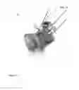 Fig. 06 - System of designing a guide tool and/ or surgical kit tools and/or an implant comprising a positioning mark