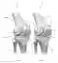 Fig. 03 - Method of implanting a unicondylar knee prosthesis
