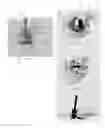 Fig. 10 - Method of implanting a unicondylar knee prosthesis