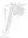 Fig. 01 - Shoulder prosthesis with variable inclination humeral head component