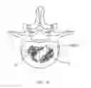 Fig. 34 - Interbody implants and graft delivery systems