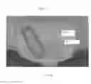 Fig. 35 - Interbody implants and graft delivery systems