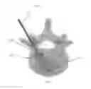 Fig. 37 - Interbody implants and graft delivery systems