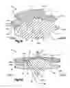 Fig. 10 - Articulating disc implant