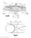 Fig. 11 - Articulating disc implant