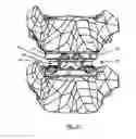 Fig. 07 - Intervertebral cage and method of treating vertebrae with an intervertebral cage