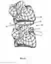 Fig. 08 - Intervertebral cage and method of treating vertebrae with an intervertebral cage
