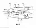 Fig. 17 - Intervertebral cage and method of treating vertebrae with an intervertebral cage