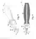 Fig. 06 - Surgical method for implanting a stemless humeral component to the humerus of a patient