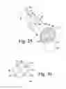 Fig. 14 - Surgical method for implanting a stemless humeral component to the humerus of a patient