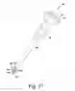 Fig. 19 - Surgical method for implanting a stemless humeral component to the humerus of a patient
