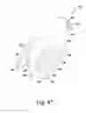 Fig. 24 - Surgical method for implanting a stemless humeral component to the humerus of a patient