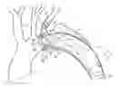 Fig. 01 - Multi-component stent-graft system for aortic dissections