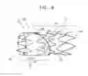 Fig. 08 - Multi-component stent-graft system for aortic dissections
