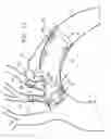 Fig. 10 - Multi-component stent-graft system for aortic dissections
