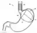 Fig. 01 - Upper stomach gastric implants