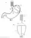 Fig. 02 - Upper stomach gastric implants