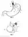 Fig. 04 - Upper stomach gastric implants