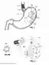 Fig. 05 - Upper stomach gastric implants