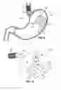 Fig. 06 - Upper stomach gastric implants