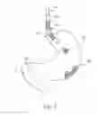 Fig. 06 - Magnetic device to control obesity and related method of use