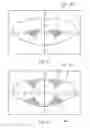 Fig. 28 - System and apparatus for treating the lens of an eye