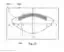 Fig. 34 - System and apparatus for treating the lens of an eye