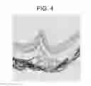 Fig. 05 - Cellular Therapy for Ocular Degeneration