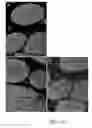 Fig. 13 - Method for decellularization of tissue grafts