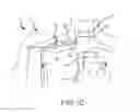 Fig. 04 - System and method to increase the overall diameter of veins