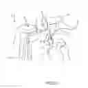Fig. 07 - System and method to increase the overall diameter of veins