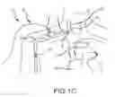 Fig. 04 - System and method to increase the overall diameter of veins