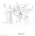 Fig. 07 - System and method to increase the overall diameter of veins