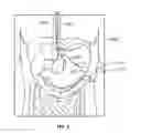 Fig. 03 - Endoscopic Lead Implantation Method