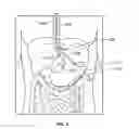 Fig. 05 - Endoscopic Lead Implantation Method