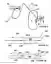 Fig. 04 - Methods and apparatus for bilateral renal neuromodulation