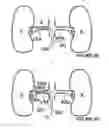 Fig. 07 - Methods and apparatus for bilateral renal neuromodulation