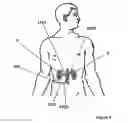 Fig. 11 - Methods and apparatus for bilateral renal neuromodulation