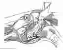 Fig. 01 - Method for modifying larynx position by trans-positioning muscle and electrode stimulation