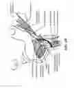 Fig. 10 - Method for modifying larynx position by trans-positioning muscle and electrode stimulation