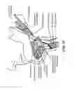 Fig. 12 - Method for modifying larynx position by trans-positioning muscle and electrode stimulation