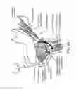Fig. 13 - Method for modifying larynx position by trans-positioning muscle and electrode stimulation
