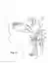 Fig. 16 - Methods for treatment of sleep apnea