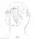 Fig. 05 - Surgical method for implantable head mounted neurostimulation system for head pain