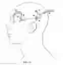 Fig. 10 - Surgical method for implantable head mounted neurostimulation system for head pain