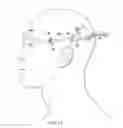 Fig. 11 - Surgical method for implantable head mounted neurostimulation system for head pain