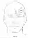Fig. 12 - Surgical method for implantable head mounted neurostimulation system for head pain