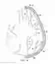 Fig. 16 - Surgical method for implantable head mounted neurostimulation system for head pain
