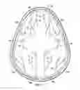 Fig. 17 - Surgical method for implantable head mounted neurostimulation system for head pain